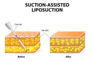 Laser Liposuction Bauch